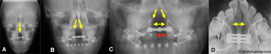 Vue de face (antéro-postérieure), une radiographie montre clairement l'ouverture au niveau de la suture palatine indiquée par les flèches jaunes. A, B et C représentent la même radiographie agrandie. On y voit aussi la vis d'expansion qui a atteint son ouverture maximale. La flèche rouge en (C) indique l'ouverture entre les incisives centrales. (D) Radiographie occlusale où l'ouverture de la suture est clairement visible. Les régions plus foncées sur les radiographies sont l'endroit où les os du maxillaire se sont séparés.