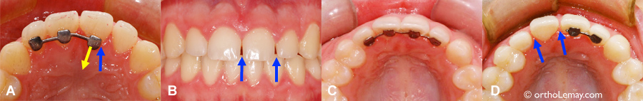 Bris de fil ou d'attelle de rétention orthodontique fixe et apparition d'espace inter-dentaire