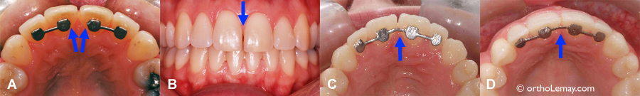 Bris d'attelles de contention orthodontique fixes