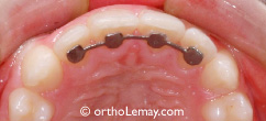Attelle de rétention orthodontique fixe collée sur les dents. Contention fixe 