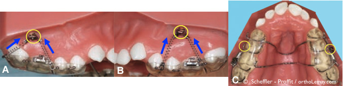Utilisation de TAD mini-vis d’ancrage pour corriger une béance antérieure en orthodontie sans chirurgie.