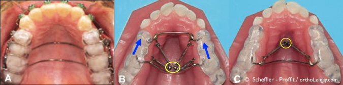 Différents types d'appareils dentaires / orthodontiques utiliés pour corriger une béance antérieure