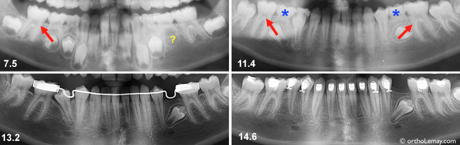 Utilisation d'un mainteneur d'espace en orthodontie pour aier l'éruption de prémolaires ectopiques. 