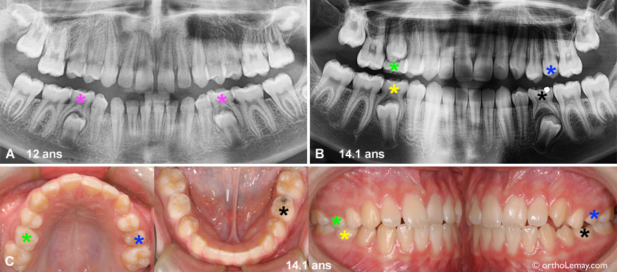 Exemples de dents temporaires (dents de lait) présentes en bouche au début du traitement d'orthodontie. 