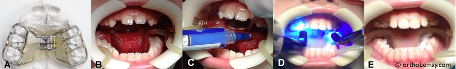 Étapes principales de la pose d'un appareil d'expansion maxillaire rapide. (A) Appareil d'expansion tel qu'il est reçu du laboratoire. (B) Écarteurs et pompes à salive (succion) pour isoler la dentition et la garder au sec. (C) Mordançage (etching) de la surface des dents. Après avoir nettoyé et asséché la surface des dents, un acide spécial contenu dans une seringue est appliqué sur l'émail dentaire uniquement où l'appareil doit être collé. Les dents sont à nouveau rincées et asséchées et sont alors prêtes à recevoir l'appareil. (D) La colle est posée sur l'appareil qui est ensuite placé sur la surface des dents. Des lumières bleues spéciales font durcir la colle rapidement (polymérisation). Cette étape dure moins de 30 secondes. (E) Résultat final avec l'appareil d'expansion bien collé. Toute cette procédure ne prend que quelques minutes.