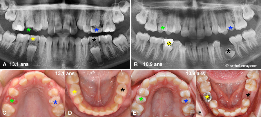 Exemple de situations où un traitement d'orthodontie pourrait être débuté même si des dents de lait (temporaires) sont enore en bouche.