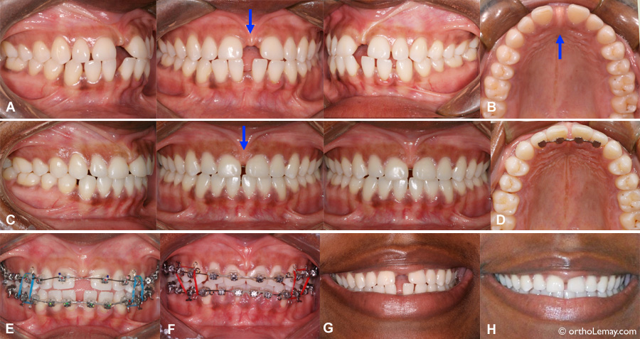 Fermeture partielle d'un espace inter-dentaire (diastème).