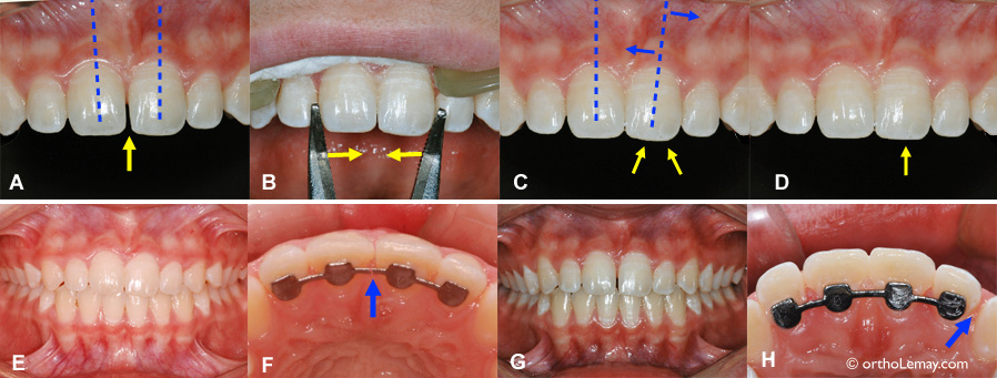 diasteme fermeture espace pince orthodontie 103258 RB16