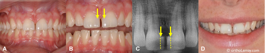 Centrales élargies avec du composite pour fermer un large diastème. Les dents sont maintenant troplarges et inesthétique. L'orthodontie peut corriger la position des dents et améliorer l'esthétique. 