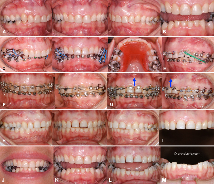 Inter-disciplinary orthodontic treatment of an adult having significant wear necessitating crowns after the treatment.