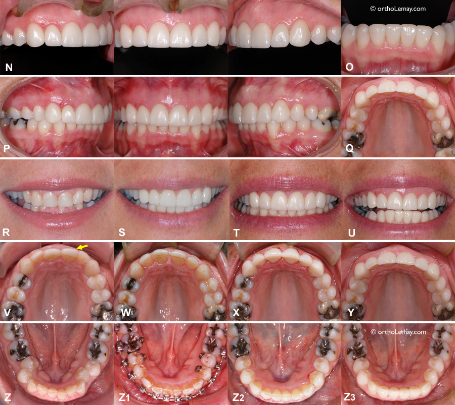 Traitement en orthodontie et prosthodontie d'un adulte avec usure dentaire importante. 