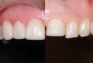 orthodontie inter-isciplinnaire. Corrrection dune importante malocclusion pour permettre au dentiste de restaurer des dents sévèrement usées et améliorer l'esthétique.