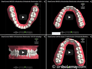 Simulation virtuelle de traitements avec gouttières transparentes ClearCorrect, similaire à Invisalign