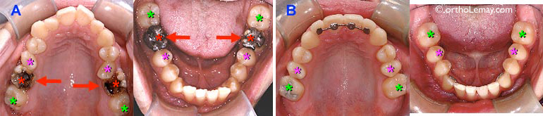 Extraction de molaires et fermeture d'espace en orthodontie. 
