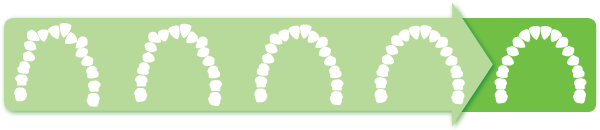 Étapes dans la orrections d'une malocclusion avec les aligneurs invisibles ClearCorrect.orthodontie invisible. orthodontisteSherbrooke 