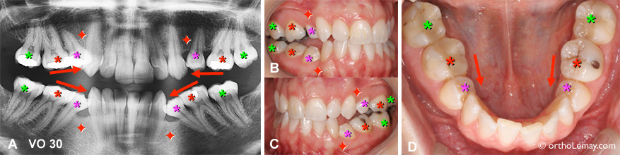 Extraction des premières prémolaires ayant causé la migration et bascule vers l'avant des autres dents postérieures. Des corrections orthodontiques peuvent redresser ces dents. 