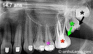 Extraction d'une molaire endommagée et éruption des autres molaires dans l’espace d'extraction. 