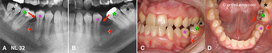 Extraction des premières molaires inférieures et bascule des autres molaires. Les dents basculées peuvent être redressées en orthodontie.