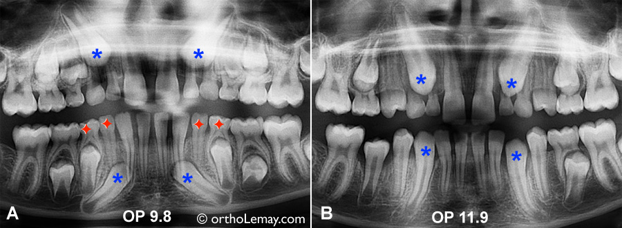 Extractions sélectives, extractions pilotées permettant d'améliorer la direction d'éruption de canines ectopiques et de minimiser les chances de problèmes d'éruption et de dommage aux dents. 