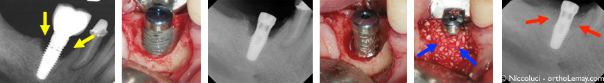 Péri-implantite autour d'un implant dentaire