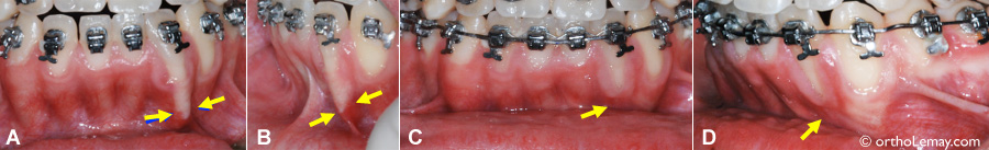 Correction d'une racine trop inclinée qui sort partiellement de l'os en orthodontie.