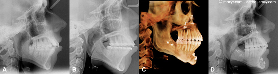 Chirurgie orthognathique bimaxillaire; radiographies céphalométrique et volumique. ortho-chirrurgie