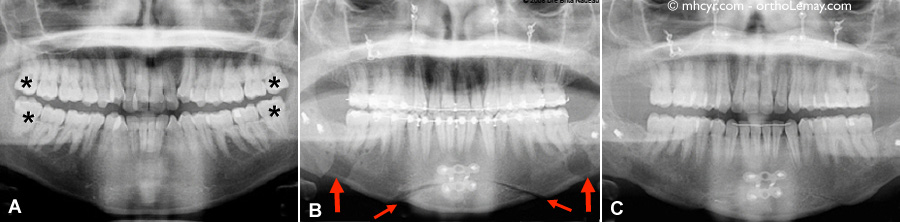 Radiographies panoramiques montrant des fisations chirurgicales rigides utilisées lors d,une chirurgie orthognathique bimaxillaire