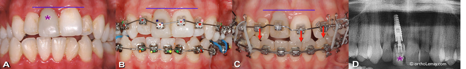 Implant dentaire sur une incisive centrale supérieure posé avant l'orthodontie. Implant dentaire sur une incisive centrale supérieure (*) posé avant un traitement d"orthodontie.