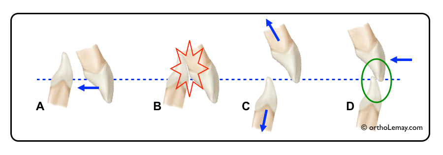 La rétraction ou le recul des dents antérieures ne peut se faire sans modifier le surplomb vertical.