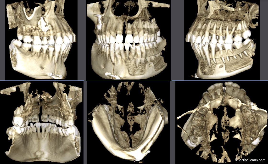 Exemple de volume 3 D de tomodensitométrie volumique à faisceau conique (TVFC) CBCT antérieur