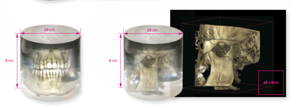 tomodensitométrie volumique à faisceau conique (TVFC) Volume de 8 cm x 8 cm CBCT 