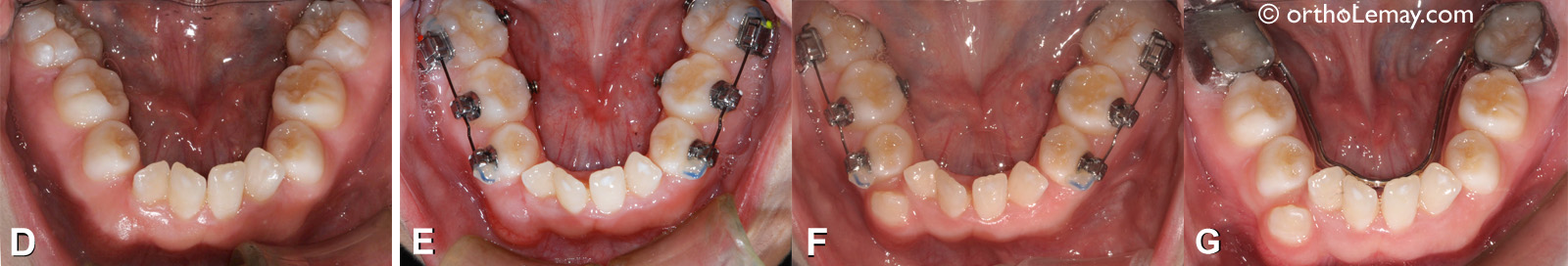 Expansion mandibulaire en orthodontie pour traiter l'apnée du sommeil chez un enfant. 