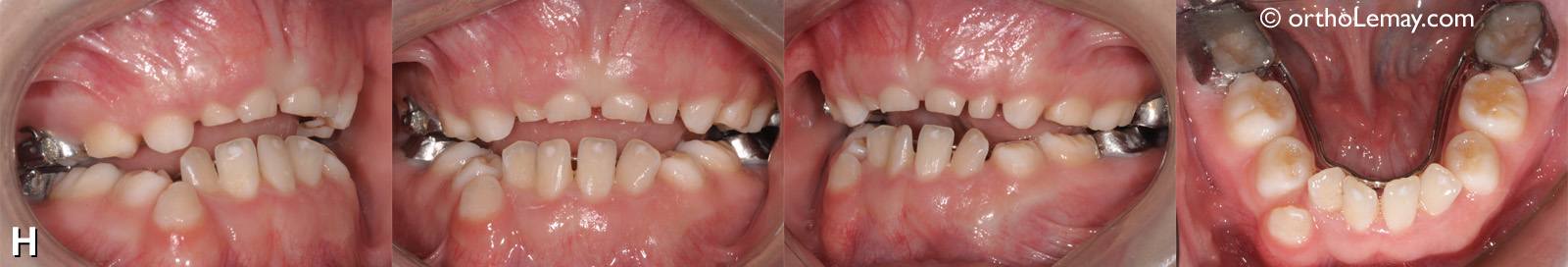 Préservation de l'expansion mandibulaire à l'aide d'un mainteneur d'espace lingual. 