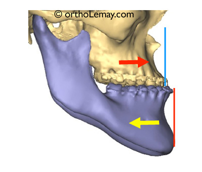 Chirurgie orthognathique pour malocclusion classe III nécessitant un avancement maxillaire et un recul mandibulaire. 