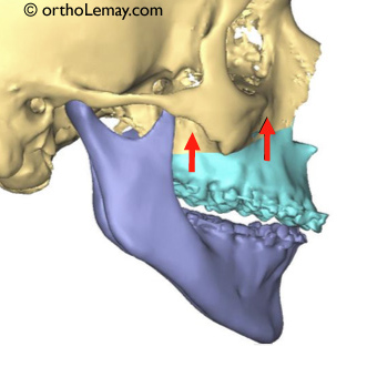 Impaction maxillaire chirurgicale. Orthodontie et chirurgie orthognathique. Fermeture d'une béance antérieure.