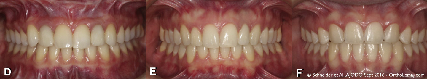 comparaison-esthetique-5_3_6-incisive-laterale-canine-orthodontie-implant-schneider-ajodo-2016