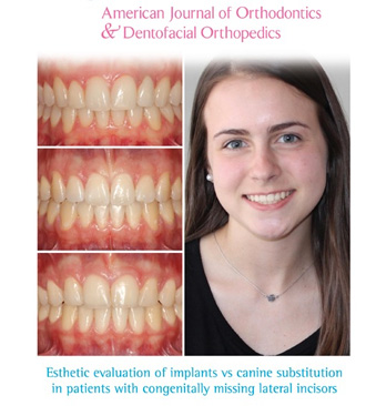 AJODO cover sept 2016 Schneider. Anodontie latérale, évaluation implants vs substitution de canines en orthodontie. 