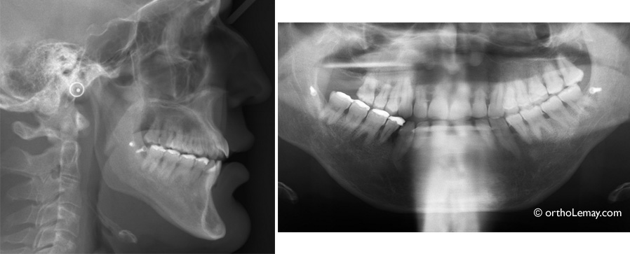 Radiographie panoramique et céphalométrique d'un cas chirurgical avec menton fort et problèmes de parodontie.