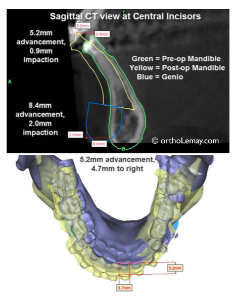 Simulation chirurgicale en 3D avec le logiciel Proplan pour une malocclusion classe 2. Ortho-chirurgie. 