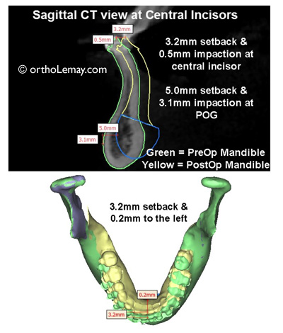 Simulation 3D d'une correction chirurgicale d'une malocclusion classe 3 avec prognathie mandibulaire. 