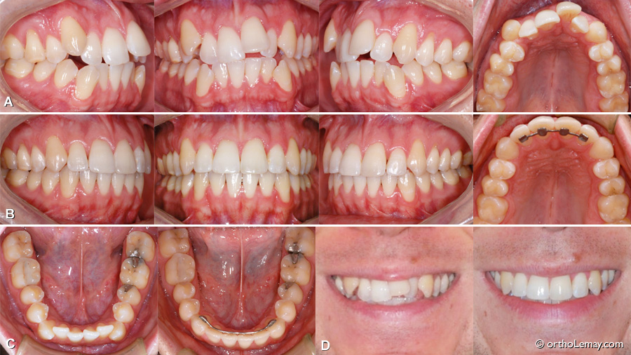 Malocclusion classe 1 traitement d'orthodontie adulte sans extraction ou chirurgie. Chevauchement dentaire. 