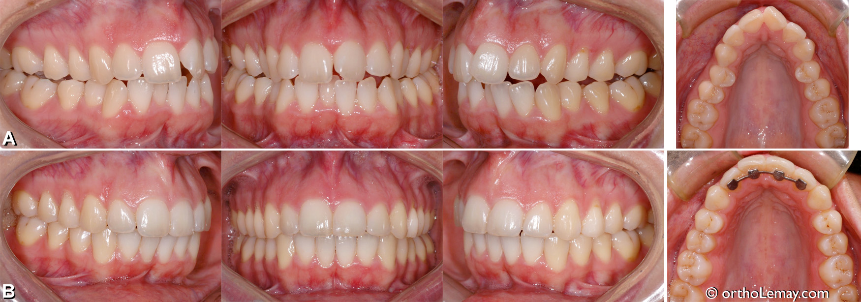 Malocclusion dentaire classse 1 orthodontie adulte expansion non chirurgicale sans EPRAC