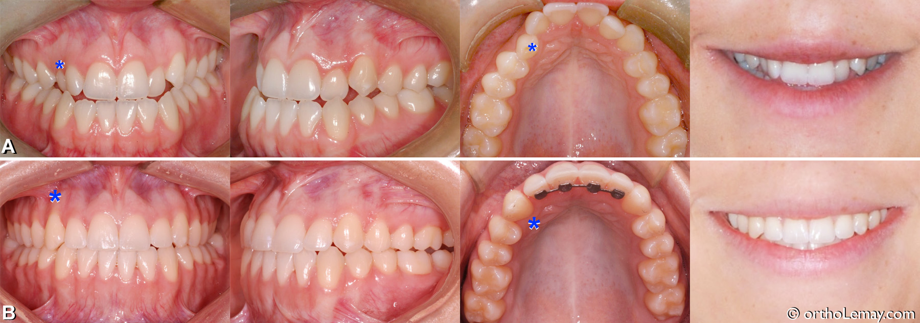 Correction d'une malocclusion dentaire classe 3 (III) avec déficience maxillaire et canine incluse chez une jeune adulte. 