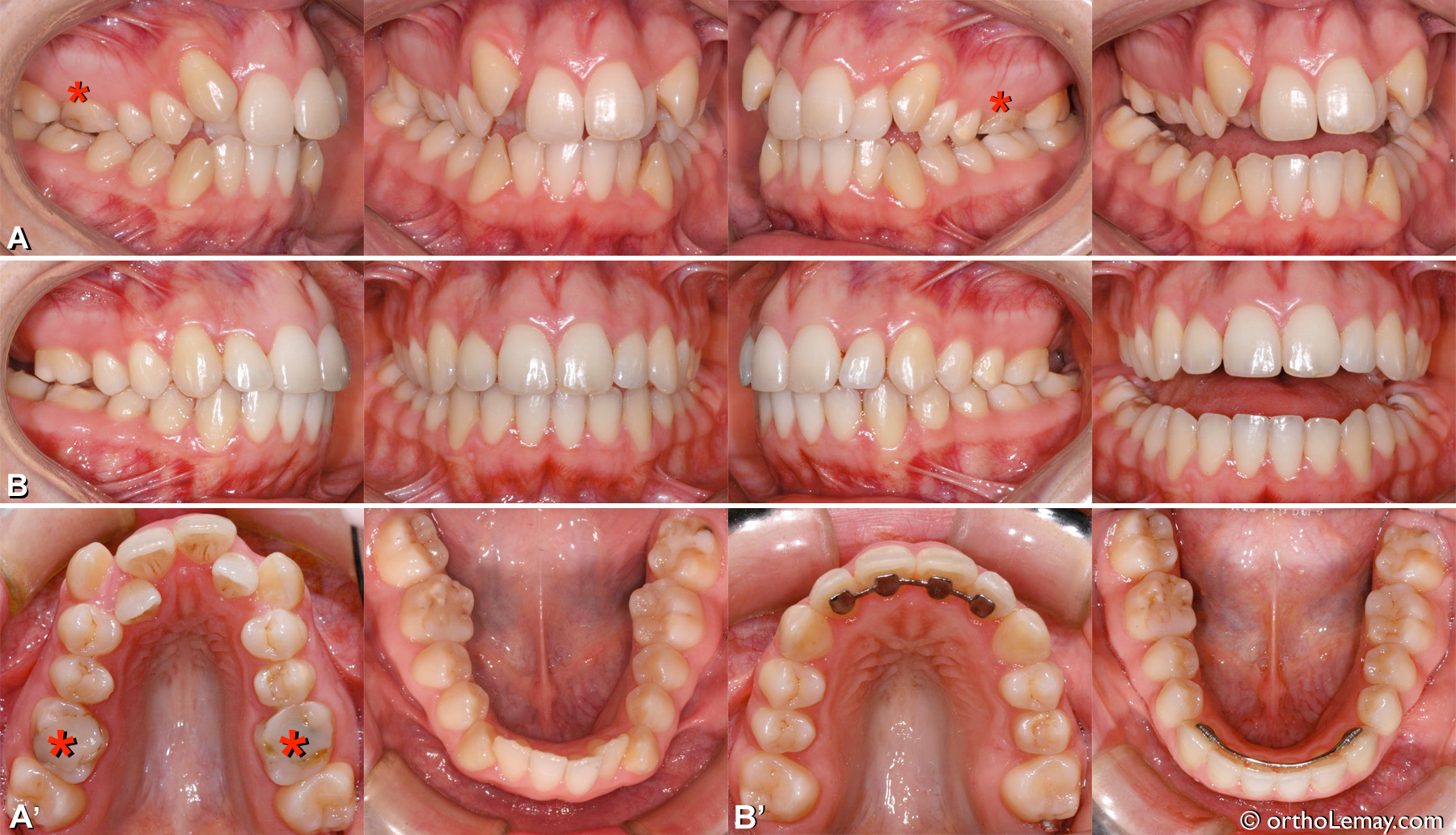 Malocclusion classe 2 adulte avec chevauchement dentaire important, maxillaire étroit, occlusion croisée. Traitement d'orthodontie avec extraction des premières molaires supérieures.