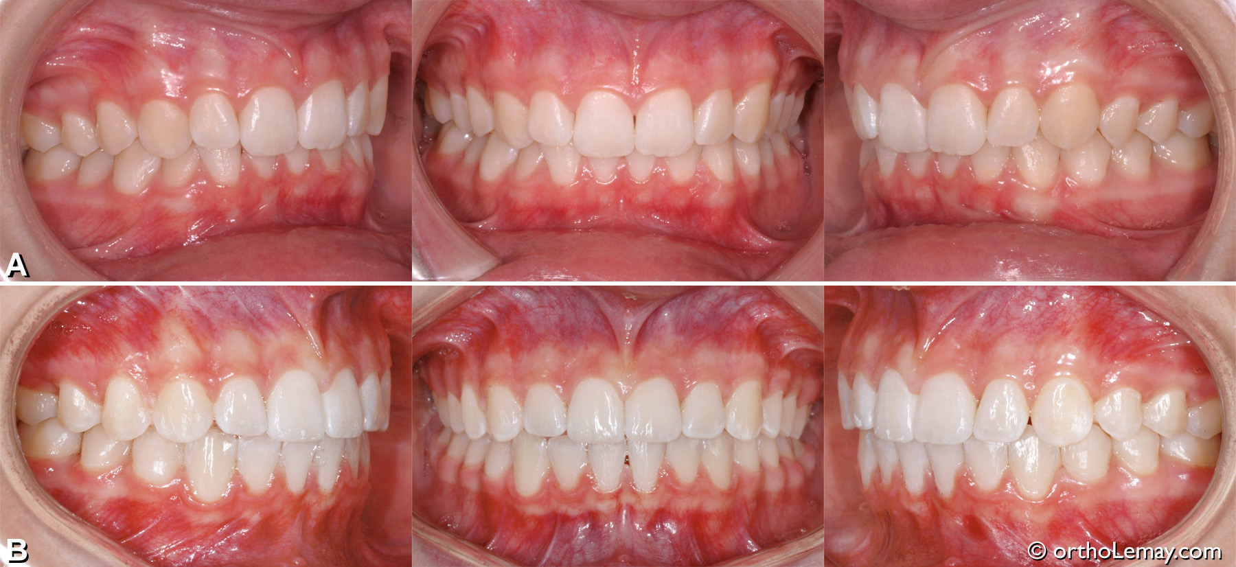 Malocclusion dentaire CL1 avec overbite et déviation des lignes médianes.