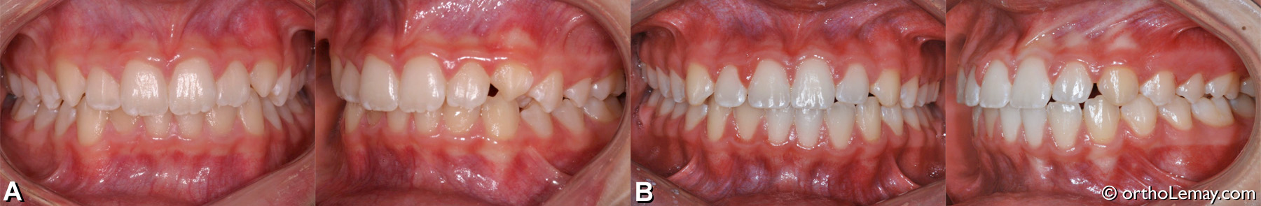 malocclusion dentaire classe 1, chevauchement dentaire, corrections orthodontiques adolsecent. Orthodontie Sherbrooke 