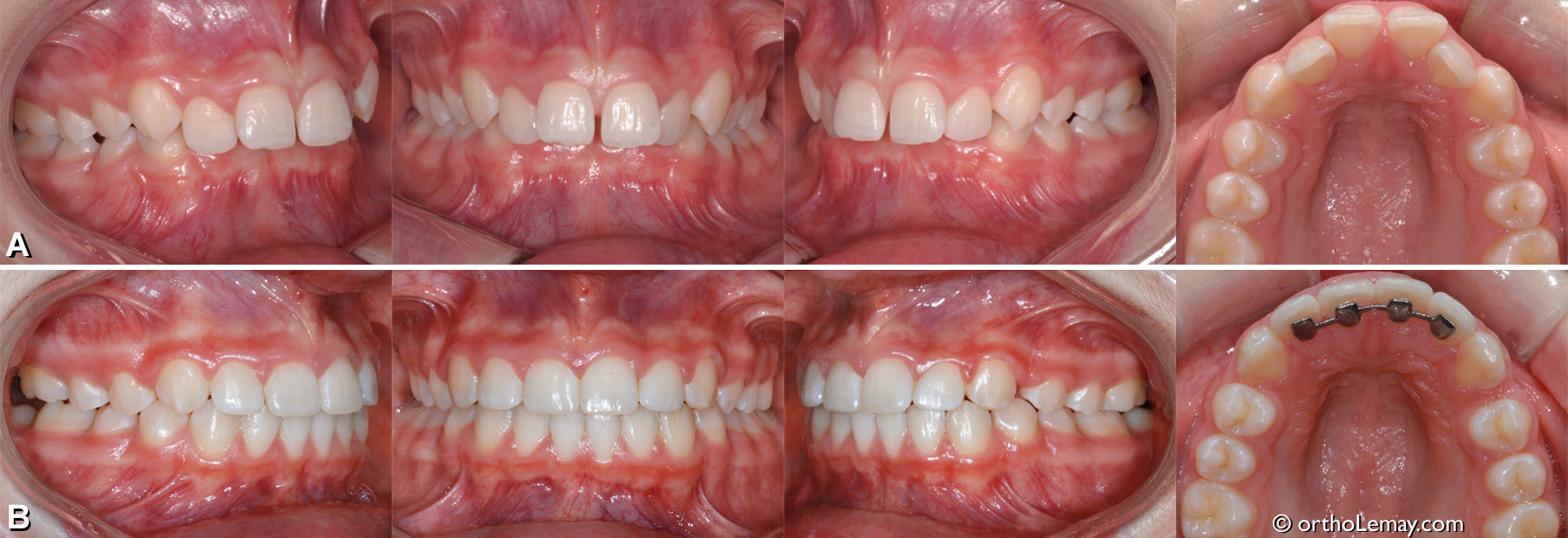 (A) Sévère malocclusion de type classe 2 division 1 avec surplomb antérieur horizontal excessif (9 mm), supraclusion antérieure (100 % de surplomb) et arcades étroites. (B) APRÈS 20 mois de traitement l'overbite et l'overjet (surplomb horizontal et vertical) sont régularisés, ce qui procure une fonction optimale, les arcades ont été élargies (expansion dento-alvéolaire). (Fille de 13 ans).