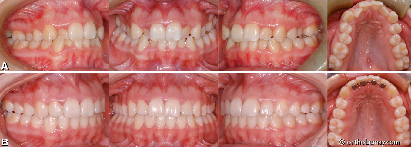 malocclusion classe 1, occlusion croisée postérieure bilatérale, chevauchement dentaire. Traitement d'orthodontie adolescent. Orthodontiste Lemay