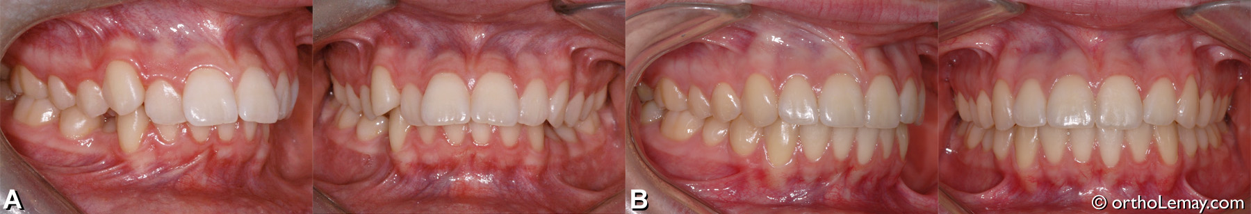 malocclusion dentaire classe 1 avec overbite et overjet excessifs. Traitement d'orthodontie adolescent