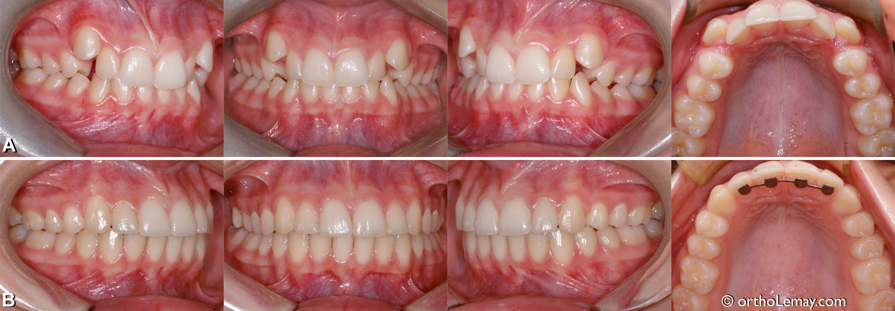 Malocclusion classe 2 division 2, canines ectopiques, crowding, manque d'espace. Traitement d'orthodontie pour adolescent